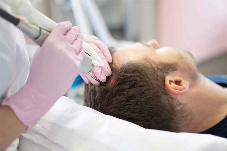عوارض لیزر تراپی مو در آقایان