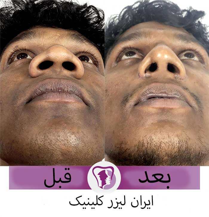 فرم‌دهی بینی با لیزر