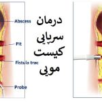 لیزر لیزر