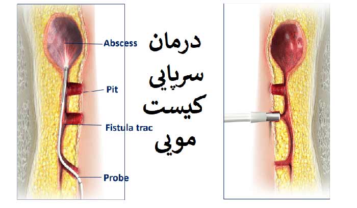 عکس بهترین کلینیک درمان کیست مویی در تهران