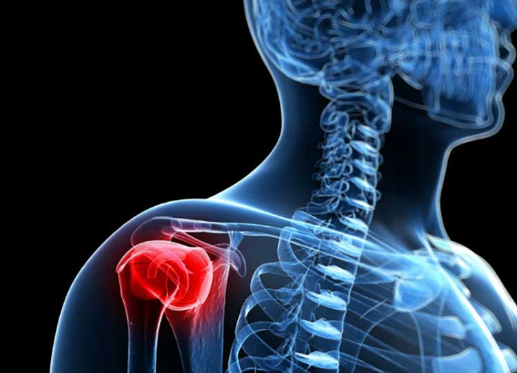 تاندون شانه عمل تاندون شانه با لیزر و قرص ترمیم تاندون شانه