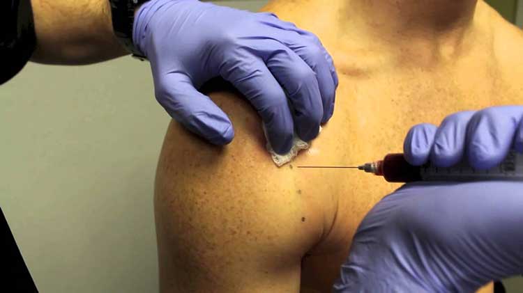 تاندون شانه تزریق پلاسما