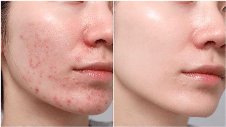 لیزر درمانی فرصتها و منابع محلی اصفهان برای درمان جای جوش