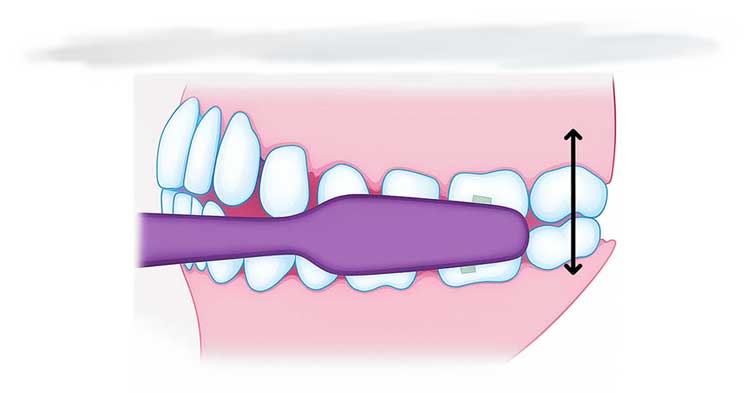 تکنیک مسواک زدن صحیح